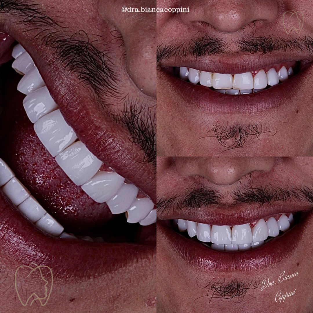 Antes e depois - Caso 1