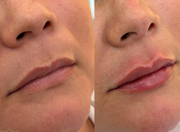 Harmonização Facial